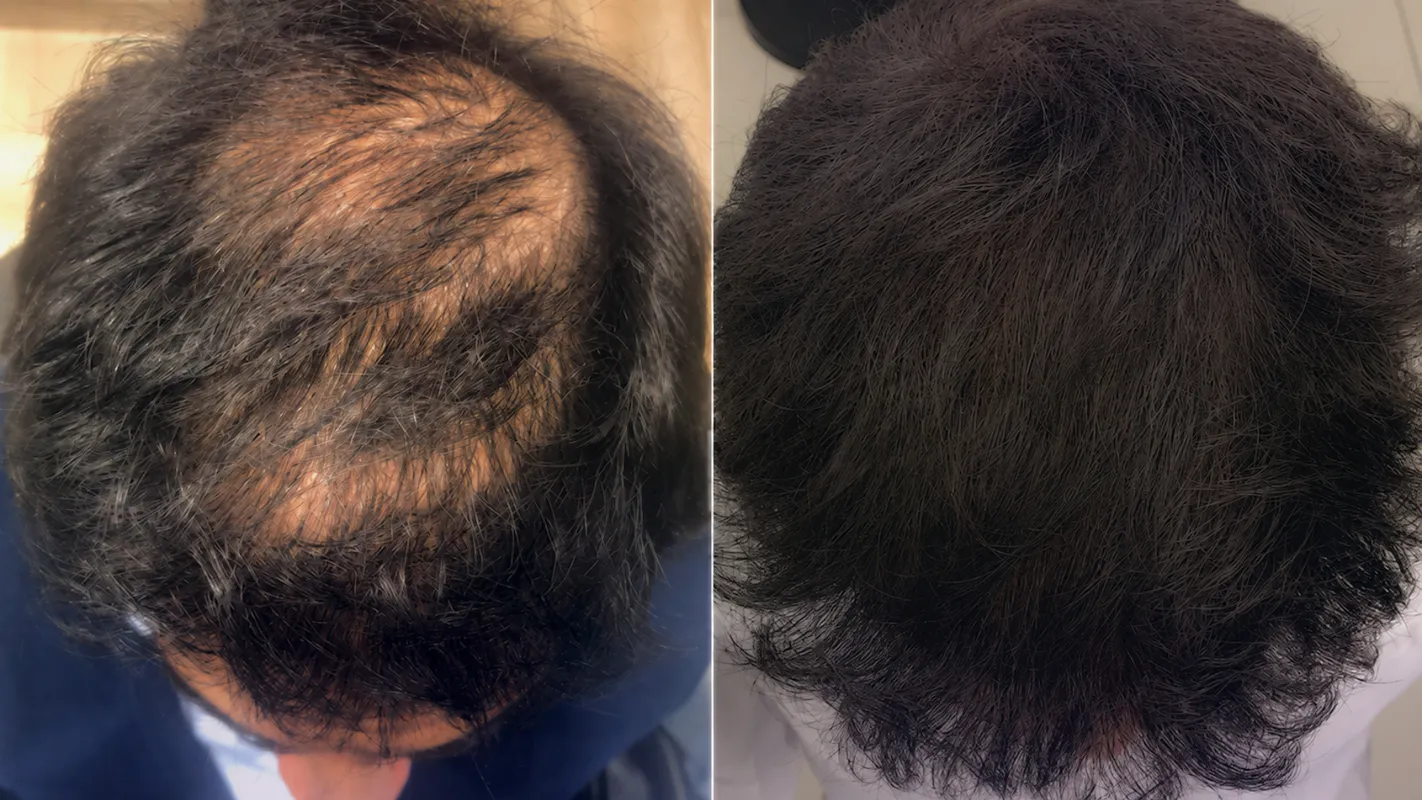 Prima e dopo il percorso HairClinic (bSBS)