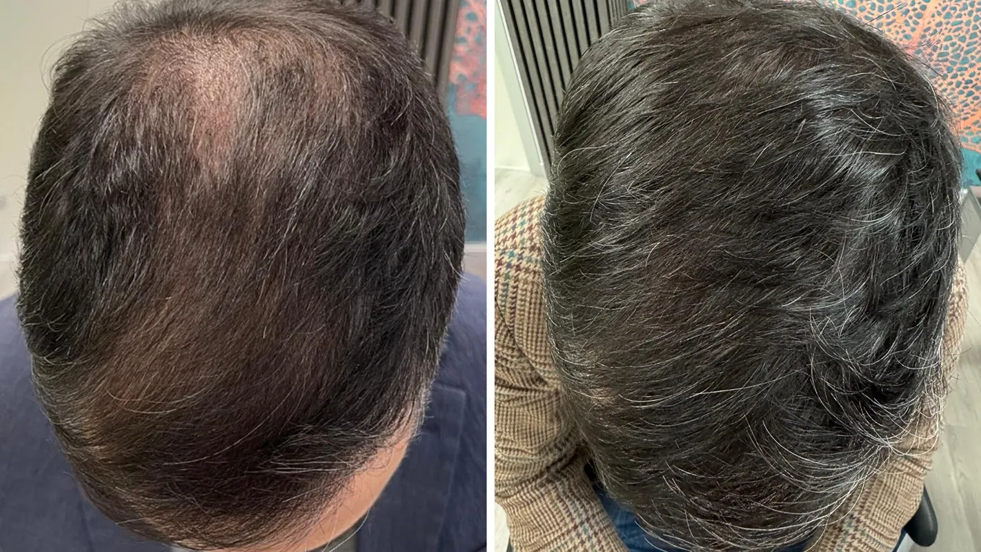 Prima e dopo il percorso HairClinic — caso 1